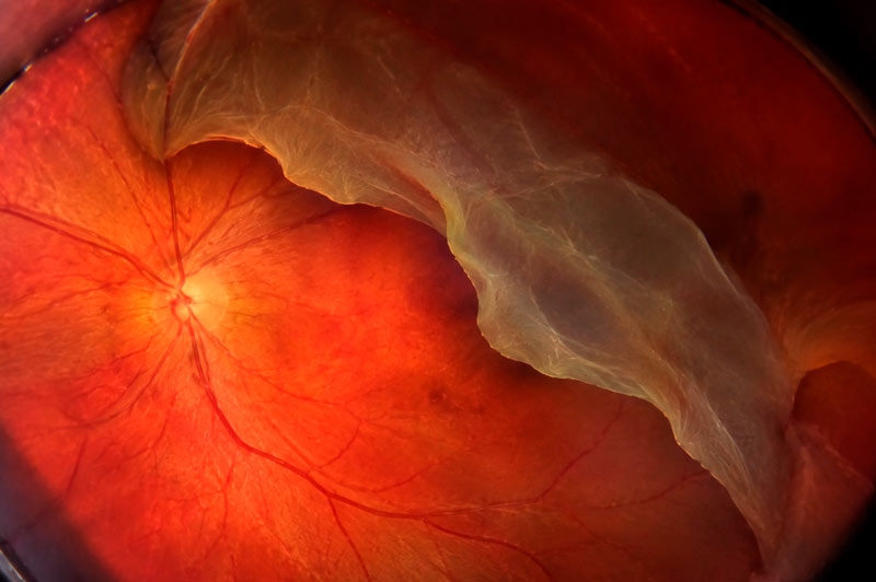 desprendimiento-retina